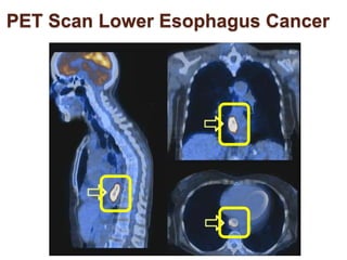 PET Scan Lower Esophagus Cancer 
 