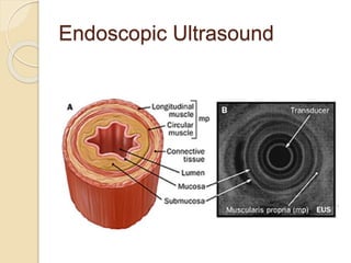 Endoscopic Ultrasound 
 
