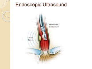 Endoscopic Ultrasound 
 