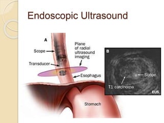 Endoscopic Ultrasound 
 