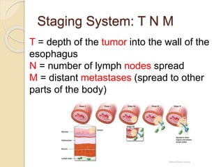 Staging System: T N M 
T = depth of the tumor into the wall of the 
esophagus 
N = number of lymph nodes spread 
M = distant metastases (spread to other 
parts of the body) 
 
