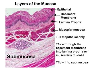 Epithelial 
Basement 
Membrane 
Lamina Propria 
Muscular mucosa 
Layers of the Mucosa 
T is = epithelial only 
T1a = through the 
basement membrane 
into lamina propria or 
muscularis mucosa 
T1b = into submucosa 
Submucosa 
 