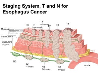 Staging System, T and N for 
Esophagus Cancer 
Tis T1 
T1 
submucosal 
intramucosal 
aorta 
T3 T4 
T2 
N0 
N1 
1-2 nodes 
Mucosa 
N2 
3-6 nodes 
N3 
7+nodes 
Submucosa 
Muscularis 
propria 
 