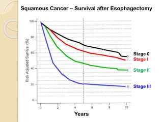 Squamous Cancer – Survival after Esophagectomy 
Years 
Stage 0 
Stage I 
Stage II 
Stage III 
 