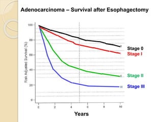 Adenocarcinoma – Survival after Esophagectomy 
Years 
Stage 0 
Stage I 
Stage II 
Stage III 
 