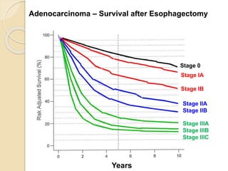 Adenocarcinoma – Survival after Esophagectomy 
Years 
Stage 0 
Stage IA 
Stage IB 
Stage IIA 
Stage IIB 
Stage IIIA 
Stage IIIB 
Stage IIIC 
 