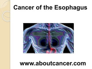 Cancer of the Esophagus 
www.aboutcancer.com 
