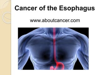 Cancer of the Esophagus 
www.aboutcancer.com 
 
