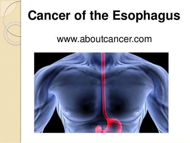Esophagus cance...