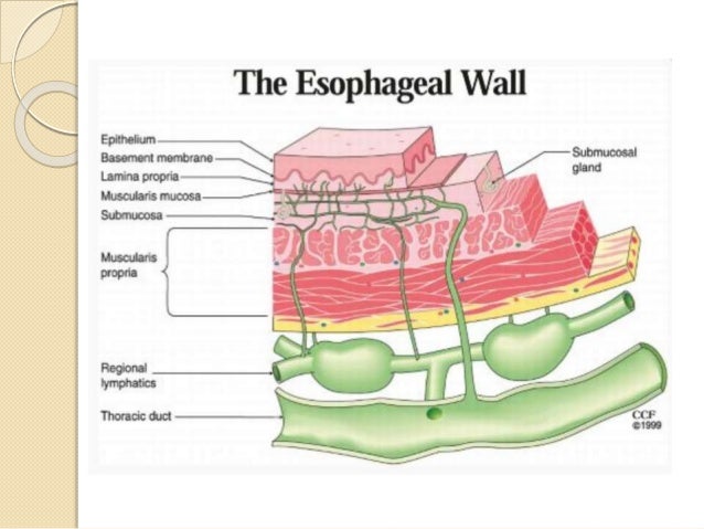 Esophagus cancer