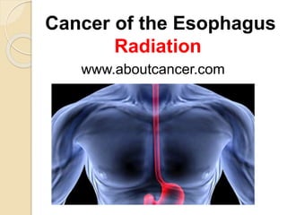 Cancer of the Esophagus 
Radiation 
www.aboutcancer.com 
 