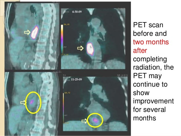 Esophagus cancer radiation treatment