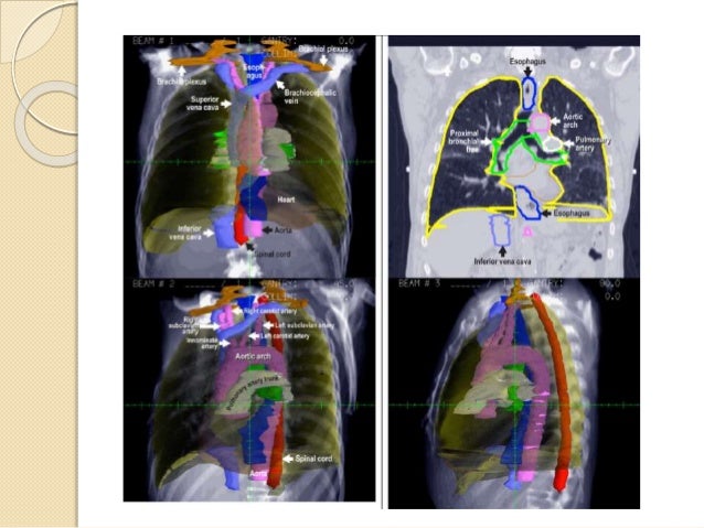 Radiation therapy for esophagus cancer