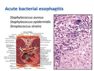 Esophagus Pathology PPTX Esophagus Pathology PPTX
