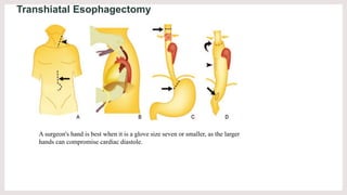 Transhiatal Esophagectomy
A surgeon's hand is best when it is a glove size seven or smaller, as the larger
hands can compr...