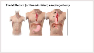 The McKeown (or three-incision) esophagectomy
 