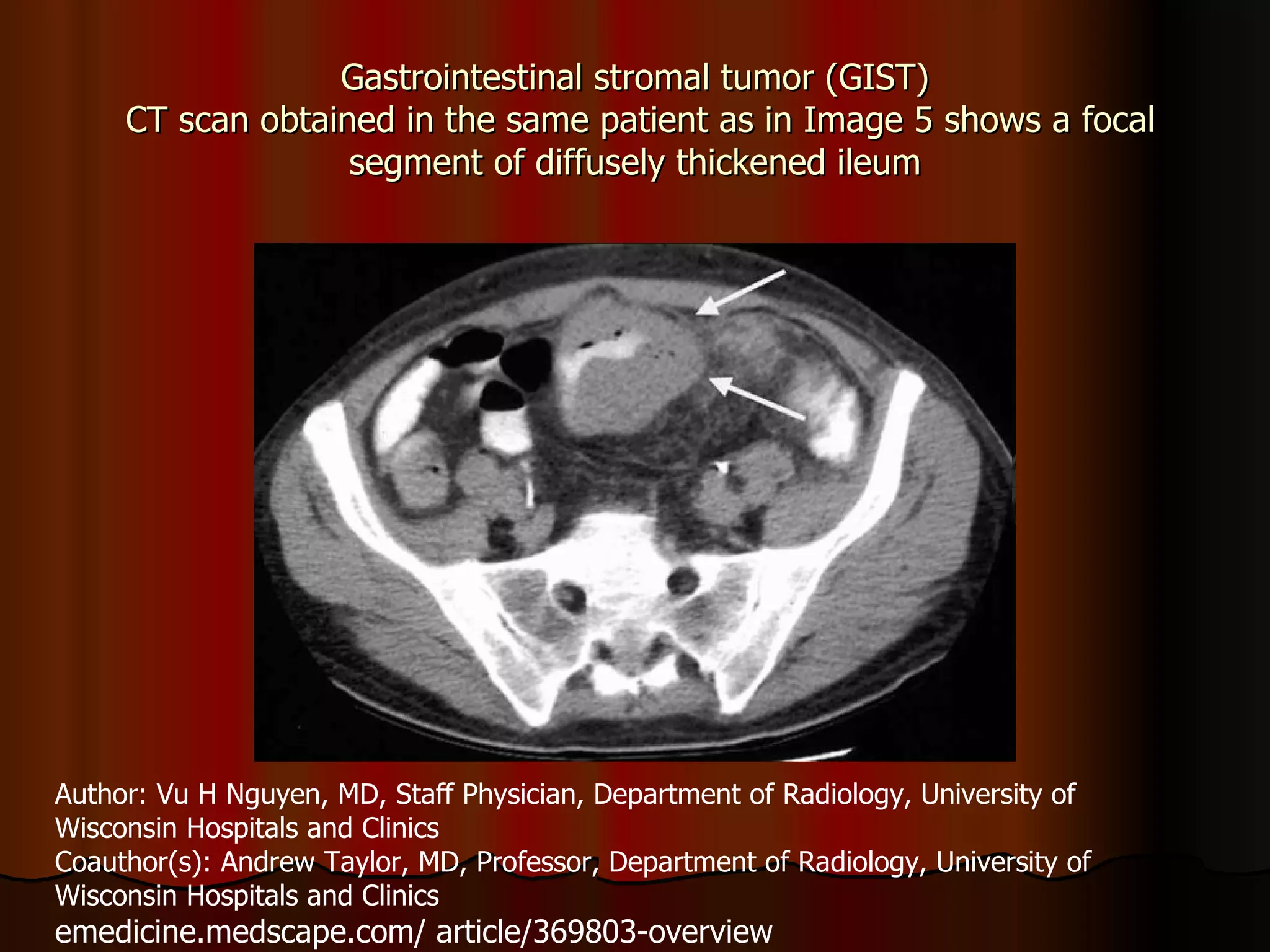 Gastrointestinal stromal tumor (GIST)  CT scan obtained in the same patient as in Image 5 shows a focal segment of diffusely thickened ileum Author: Vu H Nguyen, MD, Staff Physician, Department of Radiology, University of Wisconsin Hospitals and Clinics Coauthor(s): Andrew Taylor, MD, Professor, Department of Radiology, University of Wisconsin Hospitals and Clinics  emedicine.medscape.com/ article/369803-overview 
