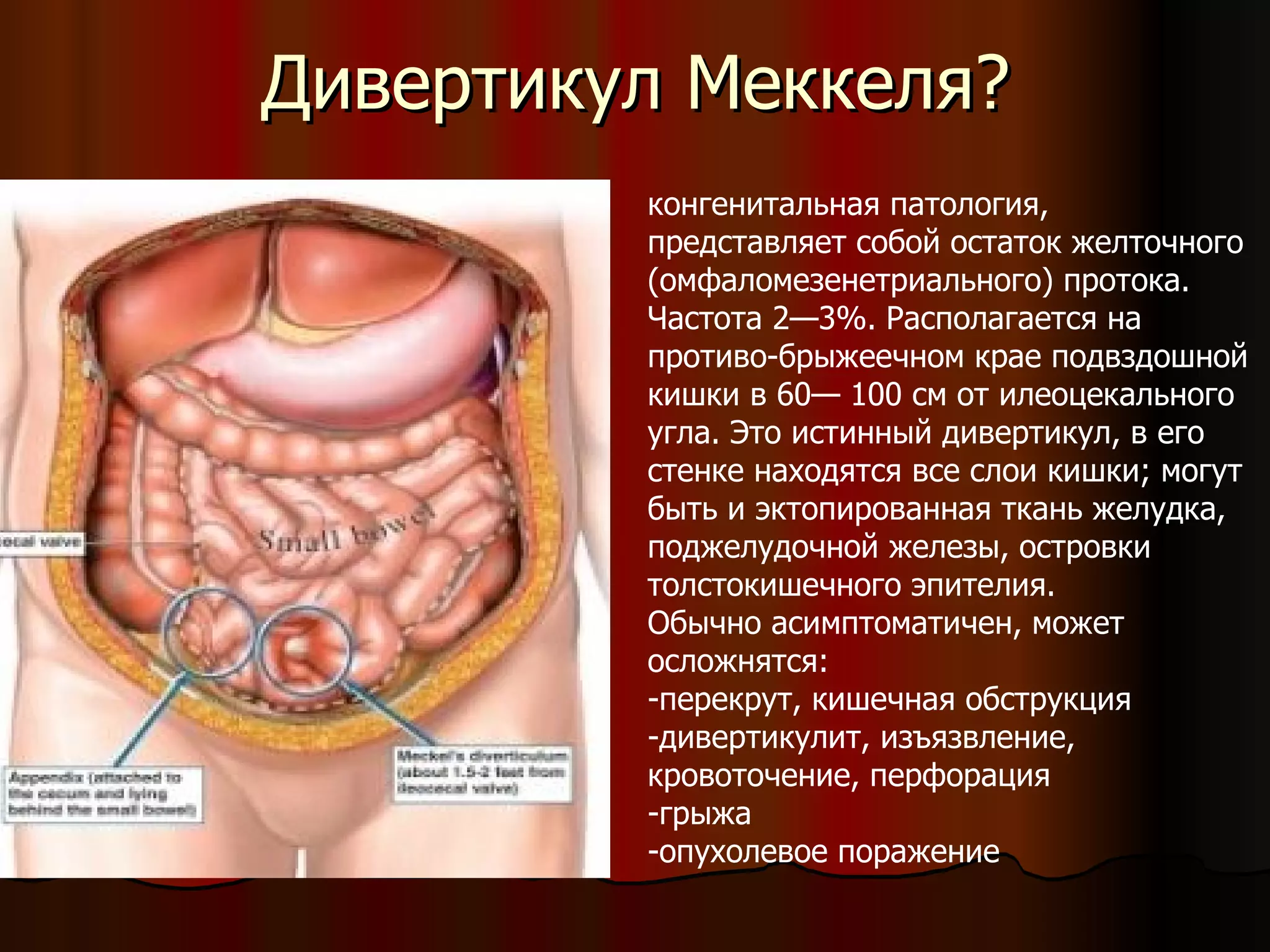 Дивертикул Меккеля? конгенитальная патология,  представляет собой остаток желточного (омфаломезенетриального) протока. Частота 2—3%. Располагается на противо-брыжеечном крае подвздошной кишки в 60— 100 см от илеоцекального угла. Это истинный дивертикул, в его стенке находятся все слои кишки; могут быть и эктопированная ткань желудка, поджелудочной железы, островки толстокишечного эпителия. Обычно асимптоматичен, может осложнятся: перекрут, кишечная обструкция дивертикулит, изъязвление, кровоточение, перфорация грыжа опухолевое поражение 