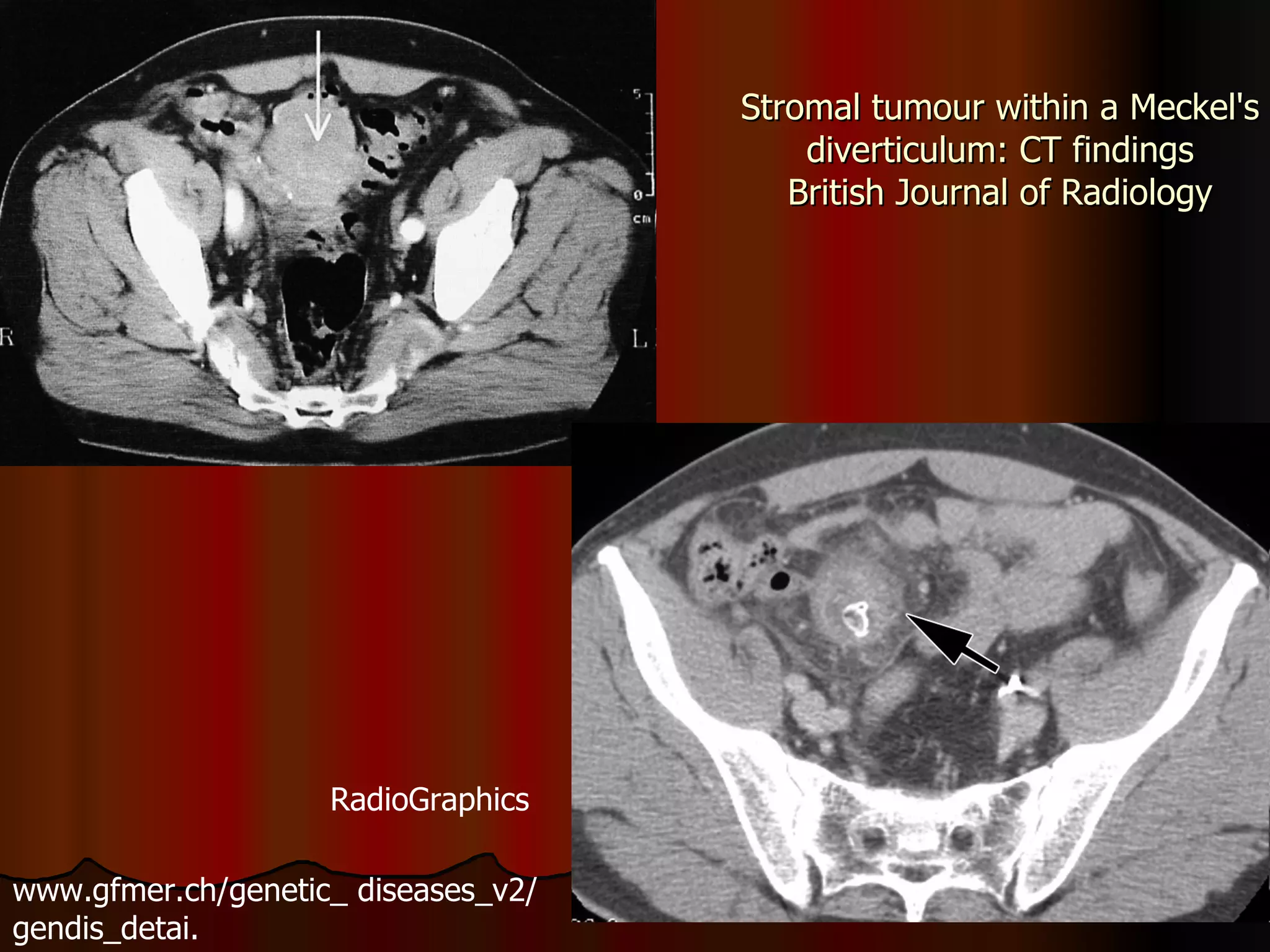 Stromal tumour within a Meckel's diverticulum: CT findings British Journal of Radiology RadioGraphics www.gfmer.ch/genetic_ diseases_v2/gendis_detai. 