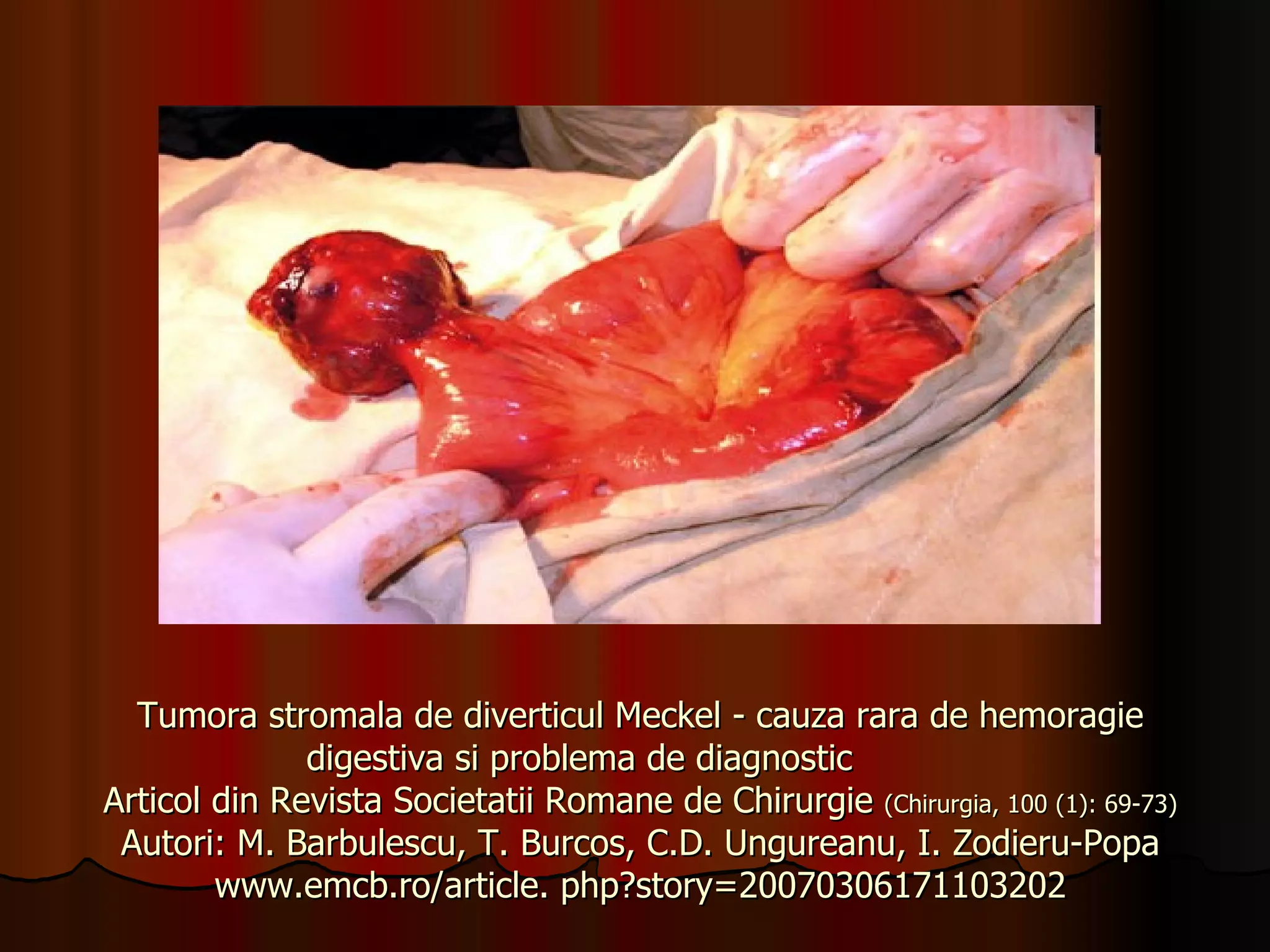 Tumora stromala de diverticul Meckel - cauza rara de hemoragie digestiva si problema de diagnostic   Articol din Revista Societatii Romane de Chirurgie  (Chirurgia, 100 (1): 69-73) Autori: M. Barbulescu, T. Burcos, C.D. Ungureanu, I. Zodieru-Popa www.emcb.ro/article. php?story=20070306171103202 