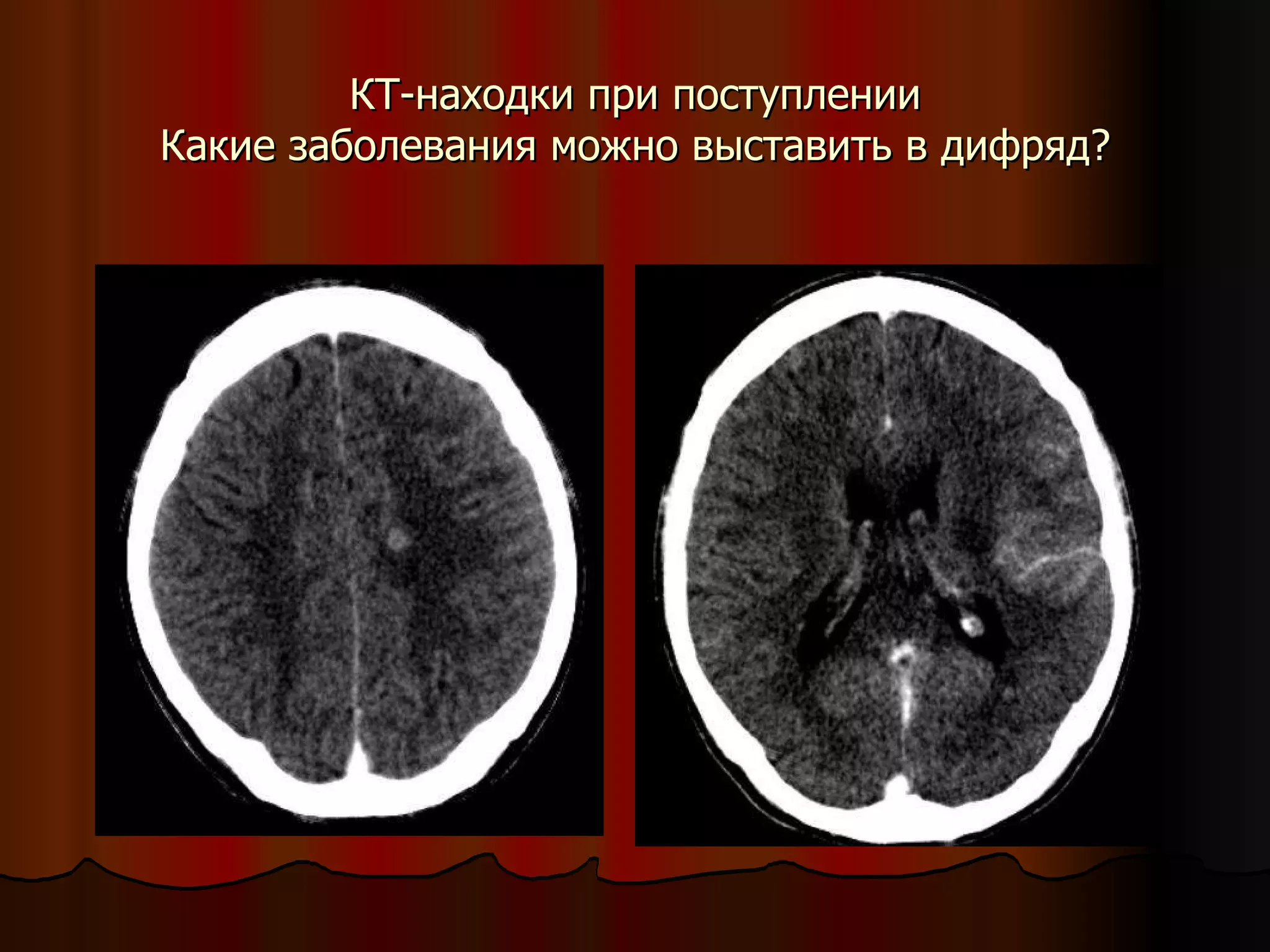 КТ-находки при поступлении Какие заболевания можно выставить в дифряд? 