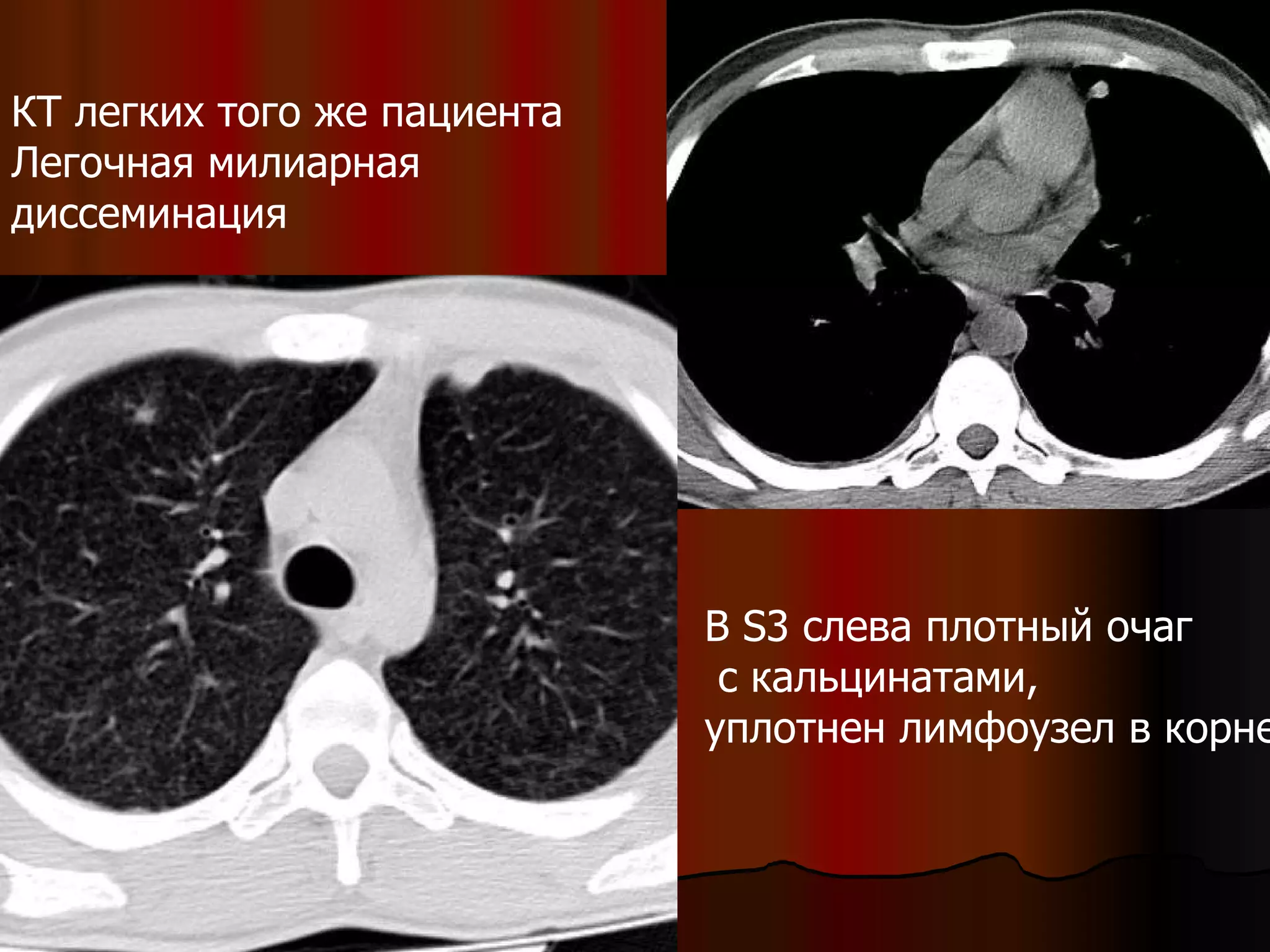 КТ легких того же пациента Легочная милиарная  диссеминация В  S3  слева плотный очаг с кальцинатами,  уплотнен лимфоузел в корне  