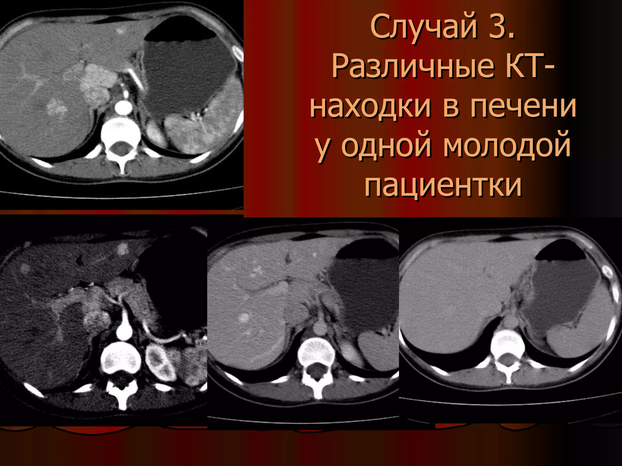 Случай 3. Различные КТ-находки в печени у одной молодой пациентки 