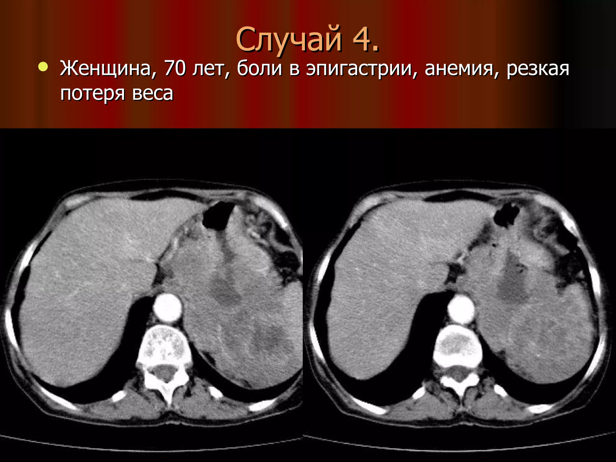 Женщина, 70 лет, боли в эпигастрии, анемия, резкая потеря веса Случай 4. 
