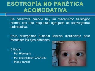 Evidencia de que el estrabismo se produce a partir de una base genética