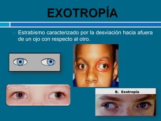Se inicia de modo típico a los 2 o 3 años de edadLa desviación es variable antes del tratamiento.Los lentes con refracción ciclopléjica completa permite que los ojos se alineenESOTROPÍA NO PARÉTICA ACOMODATIVA POR HIPEROPÍA