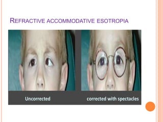 Evaluation of Esotropia in children | PPTX