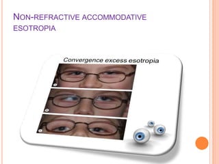 Evaluation of Esotropia in children | PPTX