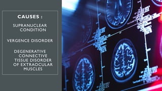 CAUSES :
SUPRANUCLEAR
CONDITION
VERGENCE DISORDER
DEGENERATIVE
CONNECTIVE
TISSUE DISORDER
OF EXTRAOCULAR
MUSCLES
 