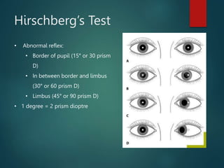Hirschberg Examples Esotropia ophthalmology presentation HSAH.pptx