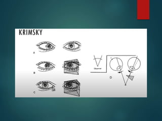 Esotropia ophthalmology presentation HSAH.pptx