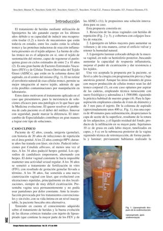 Stocchero, Ithamar N., Stocchero, Gelde H.F., Stocchero, Gustavo F., Stocchero, Vivian G.Z., Fonseca Alexandre, S.F., Fonseca Eleonora, F.S.



                                                                   Introducción   las ADSCs (1)), le propusimos una solución innova-
                                                                                  dora para su caso.
         El tratamiento de heridas mediante utilización de                           Esta propuesta consistía en:
      lipoinjertos ha ido ganando cuerpo en los últimos                              1. Resección de las áreas vaginales con heridas de
      años debido a su capacidad de inducir una recupera-                         repetición (Fig. 2 y 3), y cobertura con colgajos loca-
      ción tisular (1,2) a través de mecanismos que están                         les de rotación.
      todavía en estudio, entre los cuales están la células                          2. Lipoinjerto en labios mayores para aumentar su
      tronco y las proteínas inductoras de reacción inflama-                      volumen y de esta manera, cerrar el orificio vulvar y
      toria presentes en el tejido adiposo. La fuente de célu-                    retener la humedad natural.
      las tronco no es el adipocito en sí, sino el tejido de                         3. Lipoinjerto laminar colocado debajo de la muco-
      sustentación del mismo, capaz de regenerar el parén-                        sa vaginal, en todo su hemisferio posterior, buscando
      quima graso en ciclos estimados de entre 2 a 10 años                        aumentar la capacidad de respuesta inflamatoria,
      (2). Es una gran fuente de Factores Estromales Vascu-                       mejorar el poder de cicatrización y dar resistencia a
      lares (FEV) y de Células Tronco Derivadas del Tejido                        los tejidos.
      Graso (ADSCs), que están en la columna densa del                               Una vez aceptada la propuesta por la paciente, se
      aspirado, en el centro del mismo (Fig. 1). El no retirar                    llevó a cabo la cirugía con programación previa y bajo
      el envoltorio natural de esas células tronco, permite su                    anestesia general. Aunque las áreas donantes de grasa
      mejor integración al nuevo tejido, además de que                            con mayor producción de células tronco sean las del
      evita posibles contaminaciones por manipulación en                          tronco corporal (3), en este caso optamos por aspirar
      laboratorio.                                                                de las caderas, empleando técnica tumescente con
         Estos datos motivaron el tratamiento aplicado en el                      suero fisiológico y adrenalina a 1 /500.000, siguiendo
      caso que presentamos, pues la inexistencia de solu-                         la práctica habitual de nuestro grupo (4). Para la lipo-
      ciones eficaces para una patología es lo que hace que                       aspiración empleamos cánulas de 4 mm de diámetro y
      la Medicina evolucione. El querer resolver el proble-                       de 3 mm para el injerto. De la columna de aspirado
      ma de cada paciente es el deber del médico. Innovar                         (aproximadamente unos 400 cc. Fig. 1), tras una espe-
      con seguridad, puede marcar la diferencia. El inter-                        ra de 40 minutos para sedimentación, despreciamos la
      cambio de Especialidades contribuye en gran manera                          capa de aceite de la superficie, resultante de la rotura
      a lograr este tipo de soluciones.                                           de los adipocitos, y el líquido residual del fondo, pro-
                                                                                  ducto de la infiltración en su mayor parte. Injertamos
      CASO CLINICO                                                                10 cc de grasa en cada labio mayor, tunelizados en
         Paciente de 42 años, casada, unigesta (gemelar),                         capas, y 4 cc en la submucosa posterior de la vagina
      con historia de 20 años de infecciones de repetición                        siguiendo técnica de retroinyección, de forma parale-
      en el área genital. A los 22 años contrajo HPV; duran-                      la y laminar; previamente habíamos realizado la
      te años fue tratada con láser, sin éxito. Padeció infec-
      ciones por Cándida albicans, al menos una vez al
      mes. A los 34 años padeció herpes genital. Los epi-
      sodios de candidiasis empeoraron, alternando con
      herpes. El dolor vaginal constante le hacía imposible
      mantener una actividad sexual regular. A los 36 años
      se sometió a tratamiento de fertilización in vitro
      (FIV), con resultado de gestación gemelar llevada a
      término. A los 38 años, fue sometida a una nueva
      cauterización vaginal con láser, que evolucionó con
      ulceraciones repetidas, principalmente en dos locali-
      zaciones, siempre de muy difícil cicatrización. Pre-
      sentaba vagina seca permanentemente y no podía
      usar pantalones por dolor constante. Ante la insatis-
      facción provocada por los tratamientos convenciona-
      les y sin éxito, con su vida íntima en un nivel inacep-
      table, la paciente buscaba otra alternativa.
         Teniendo en cuenta el conocimiento adquirido                                                                      Fig. 1. Lipoaspirado des-
      sobre el tratamiento de heridas y la buena evolución                                                                 pués de la sedimentación.
      de las úlceras crónicas tratadas con injerto de lipoas-                                                              Lipoaspirado, após
      pirado (que contiene la mayor parte de los FEV y de                                                                  sedimentação.
204




       Cirugía Plástica Ibero-Latinoamericana - Vol. 35 - Nº 3 de 2009
 