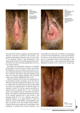 Lipoinjerto laminar: un tratamiento prometedor con factores vasculares estromales para las vulvo-vaginitis crónicas



                                           Fig. 2.                                                                            Fig. 3.
                                           Preoperatorio:                                                                     Preoperatorio: área
                                           nótese abertura y                                                                  de ulceración
                                           sequedad.                                                                          cicatrizada
                                                                                                                              marcada a las 4
                                           Pré-operatório.                                                                    horas.
                                           Notar abertura e
                                           ressecamento.                                                                      Pré-operatório.
                                                                                                                              Área de ulceração
                                                                                                                              cicatrizada ás 4
                                                                                                                              horas.




resección de dos úlceras vaginales y aproximación del              susceptibles de corrección; son debidos a un pequeño
músculo transverso superficial del perineo, con                    exceso en el cierre del perineo y a una reacción al hilo
pequeña perineoplastia posterior para el cierre (Fig.              de sutura, y no por falta de resistencia de los tejidos,
4). La paciente recibió el alta hospitalaria al día                que era el principal objetivo del tratamiento y que
siguiente de la intervención. Eliminó dos puntos inter-            obtuvo pleno éxito, ya que sabemos por Resonancia
nos de hilo de sutura de ácido poliglicólico a la tres y           Magnética realizada a los 2 meses de la cirugía, que
a las cuatro semanas.
   En cuanto a la recuperación, retomó sus actividades
profesionales a los tres días de la cirugía, sus activida-
des deportivas a las tres semanas y por recelo, no vol-
vió a mantener relaciones sexuales hasta los dos meses.
Por restricción del perineo, presentó pequeña fisura
junto a la comisura vaginal posterior tras la relación
sexual, que cicatrizó rápidamente (Fig. 5 y 6).
   Hasta el momento, tras 9 meses de seguimiento, no
ha presentado recidiva de herpes, ni de otro tipo de
infección; presenta humedad permanente de la vagi-
na, aspecto que ella desconocía ya que siempre había
convivido con sequedad local. El introito vaginal se
mantiene cerrado, los labios mayores presentan un
aspecto juvenil y turgente (Fig. 7 y 8) y la paciente
puede usar cualquier tipo de vestimenta. Sus únicas
quejas son relativas a la aparición ocasional de fisuras
en la comisura posterior tras el acto sexual, y una
pequeña herida de 3 X 1 cm., dolorosa, que ocasio-
nalmente aparece en el punto donde se colocó un
punto de sutura irreabsorbible en profundidad, pero
que no coincide con la zona donde estaban anterior-                                                                           Fig. 4.
                                                                                                                              Fin de la cirugía.
mente la úlceras provocadas por la laserterapia. Estos
problemas se producen por acción mecánica y son
                                                                                                                                                            205




                                                                                                                              Fim da cirurgia.



                                                                                          Cirugía Plástica Ibero-Latinoamericana - Vol. 35 - Nº 3 de 2009
 