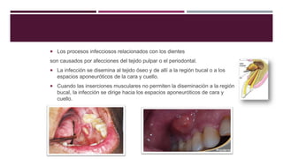  Los procesos infecciosos relacionados con los dientes
son causados por afecciones del tejido pulpar o el periodontal.
 La infección se disemina al tejido óseo y de allí a la región bucal o a los
espacios aponeuróticos de la cara y cuello.
 Cuando las inserciones musculares no permiten la diseminación a la región
bucal, la infección se dirige hacia los espacios aponeuróticos de cara y
cuello.
 