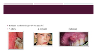  Estas se pueden distinguir en tres estados:
 1-edema 2- infiltrado 3-absceso
 