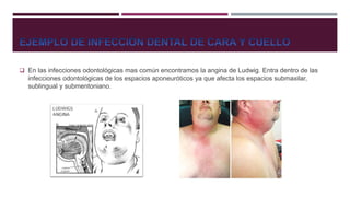  En las infecciones odontológicas mas común encontramos la angina de Ludwig. Entra dentro de las
infecciones odontológicas de los espacios aponeuróticos ya que afecta los espacios submaxilar,
sublingual y submentoniano.
 