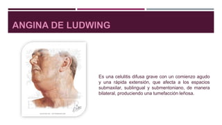 Es una celulitis difusa grave con un comienzo agudo
y una rápida extensión, que afecta a los espacios
submaxilar, sublingual y submentoniano, de manera
bilateral, produciendo una tumefacción leñosa.
 