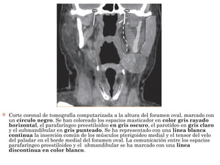  Corte coronal de tomografía computarizada a la altura del foramen oval, marcado con
un círculo negro. Se han coloreado los espacios masticador en color gris rayado
horizontal, el parafaríngeo preestiloideo en gris oscuro, el parotídeo en gris claro
y el submandibular en gris punteado. Se ha representado con una línea blanca
continua la inserción común de los músculos pterigoideo medial y el tensor del velo
del paladar en el borde medial del foramen oval. La comunicación entre los espacios
parafaríngeo preestiloideo y el ubmandibular se ha marcado con una línea
discontinua en color blanco.
 