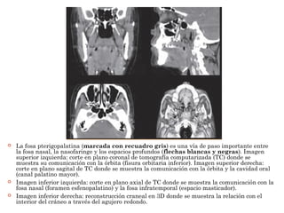  La fosa pterigopalatina (marcada con recuadro gris) es una vía de paso importante entre
la fosa nasal, la nasofaringe y los espacios profundos (flechas blancas y negras). Imagen
superior izquierda: corte en plano coronal de tomografía computarizada (TC) donde se
muestra su comunicación con la órbita (fisura orbitaria inferior). Imagen superior derecha:
corte en plano sagital de TC donde se muestra la comunicación con la órbita y la cavidad oral
(canal palatino mayor).
 Imagen inferior izquierda: corte en plano axial de TC donde se muestra la comunicación con la
fosa nasal (foramen esfenopalatino) y la fosa infratemporal (espacio masticador).
 Imagen inferior derecha: reconstrucción craneal en 3D donde se muestra la relación con el
interior del cráneo a través del agujero redondo.
 