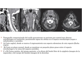  Tomografía computarizada del cuello poscontraste en paciente por control tras absceso
retrofaríngeo en resolución, persistiendo signos de edema en el espacio retrofaríngeo (supra e
infrahioideo) y carotídeo.
 A) Corte sagital, donde se marca el engrosamiento con aspecto edematoso de este espacio (flecha
negra).
 B) Corte en plano coronal, donde se mantiene un pequeño plano graso entre el espacio
retrofaríngeo y la vaina del espacio carotídeo.
 C y D) Cortes axiales, del mismo paciente, a la altura del borde libre de la epiglotis (imagen de la
izquierda) y del cuerpo del hioides (imagen de la derecha).
 