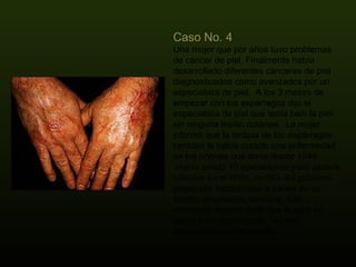 Caso No. 4  Una mujer que por años tuvo problemas de cáncer de piel. Finalmente había desarrollado diferentes cánceres de piel diagnosticados como avanzados por un especialista de piel.  A los 3 meses de empezar con los espárragos dijo el especialista de piel que tenía bien la piel sin ninguna lesión cutánea.  La mujer informó que la terapia de los espárragos también le había curado una enfermedad de los riñones que tenía desde 1949.  Había tenido 10 operaciones para sacarle cálculos en el riñón, recibía del gobierno pagos por incapacidad a causa de su estado inoperable, terminal.  Ella reconocía enteramente que la cura se debía a los espárragos.  No me sorprendió este resultado. 