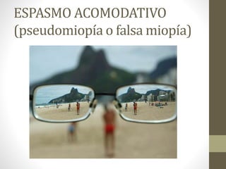 ESPASMO ACOMODATIVO
(pseudomiopía o falsa miopía)
 