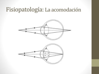 Fisiopatología: La acomodación
 