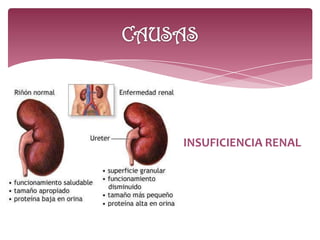 INSUFICIENCIA RENAL
 