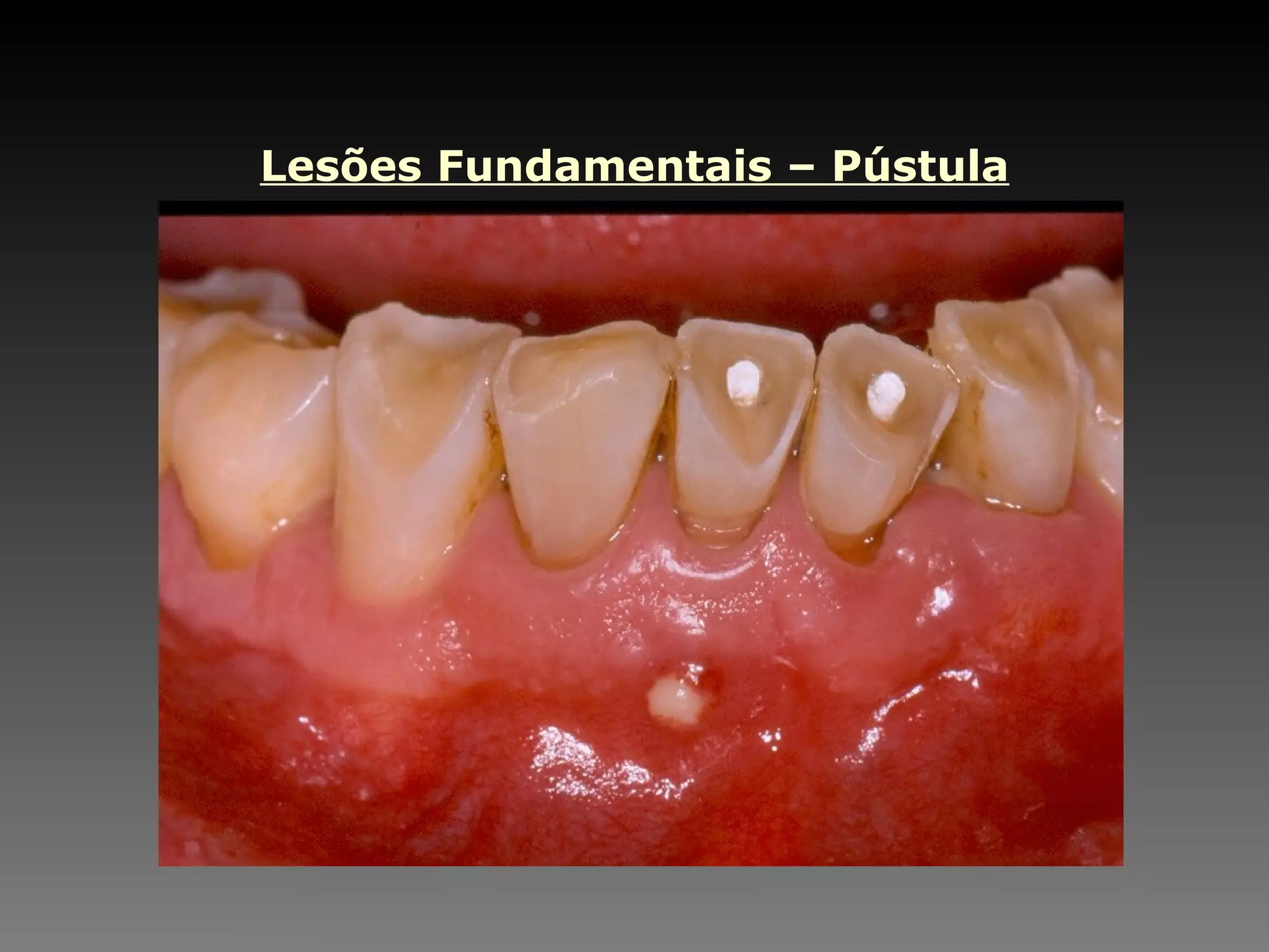 Lesões Fundamentais – Pústula 