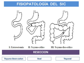FISIOPATOLOGÍA DEL SIC
Yeyuno-íleon-colon
RESECCION
Ileal Yeyunal
 